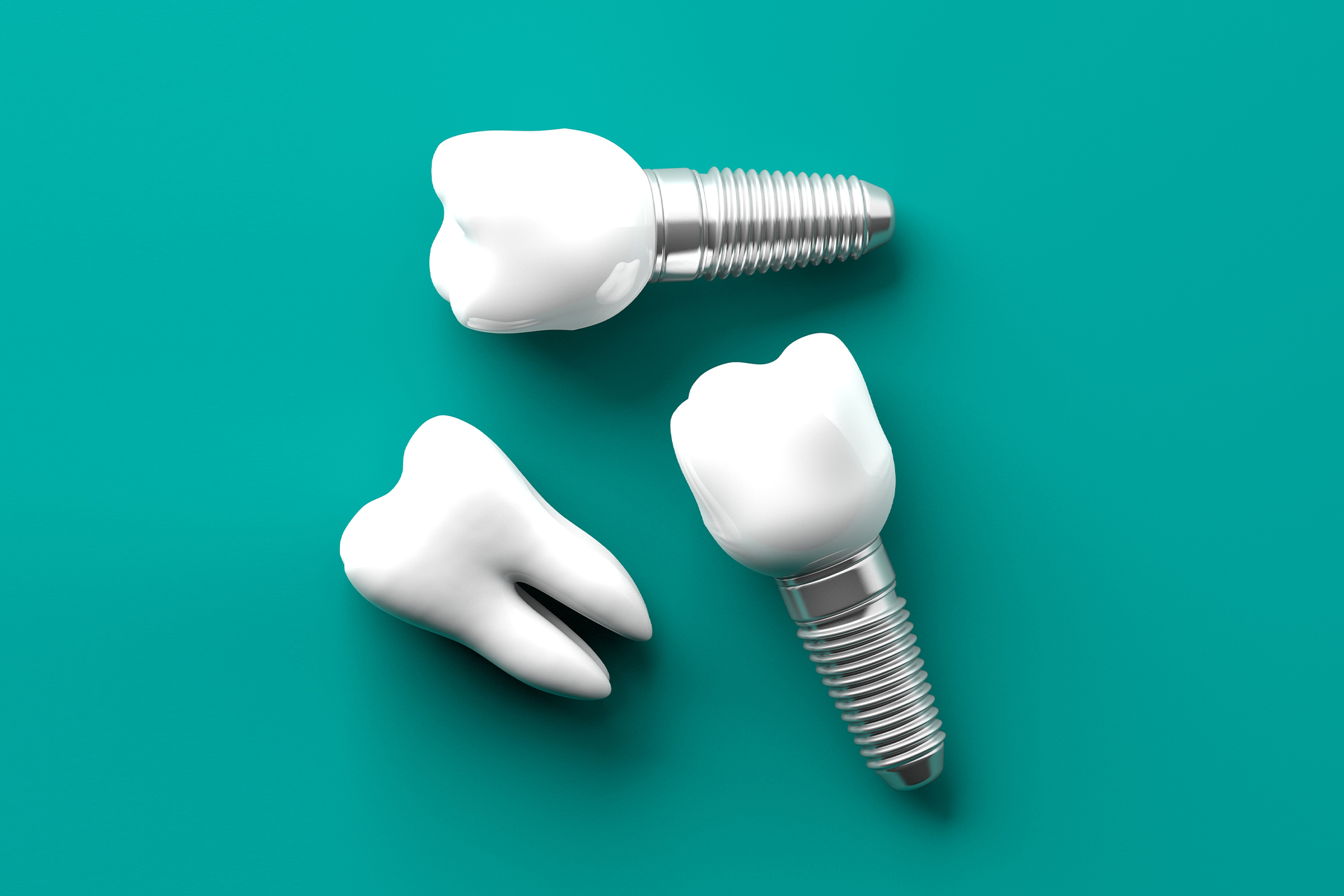 ¿Cómo funcionan los implantes dentales?